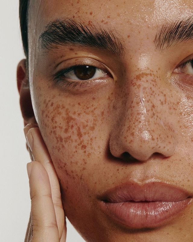 Radiofrequency Microneedling