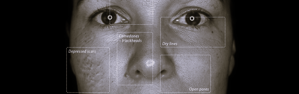 Skin Analysis
